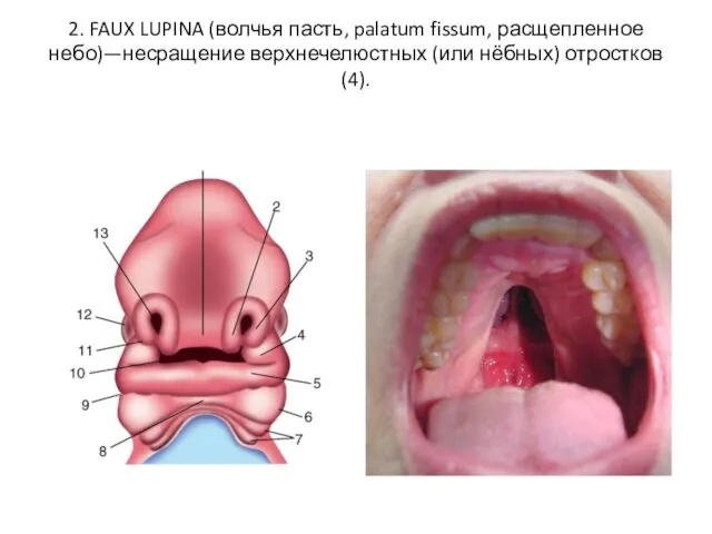 2. FAUX LUPINA (волчья пасть, palatum fissum, расщепленное небо)—несращение верхнечелюстных (или нёбных) отростков (4).
