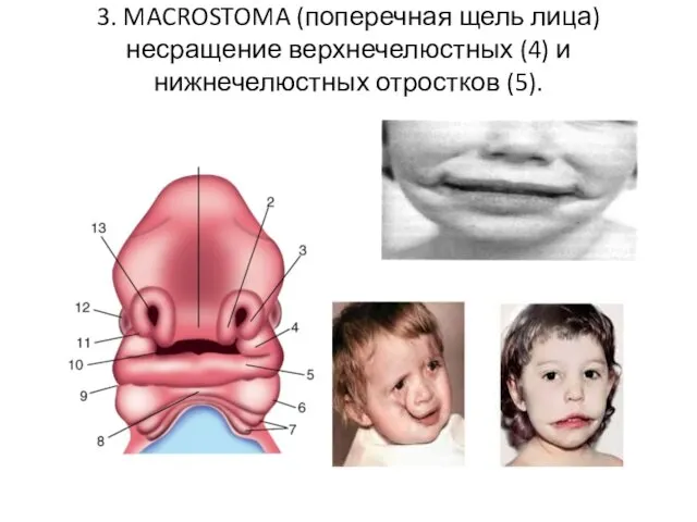 3. MACROSTOMA (поперечная щель лица) несращение верхнечелюстных (4) и нижнечелюстных отростков (5).