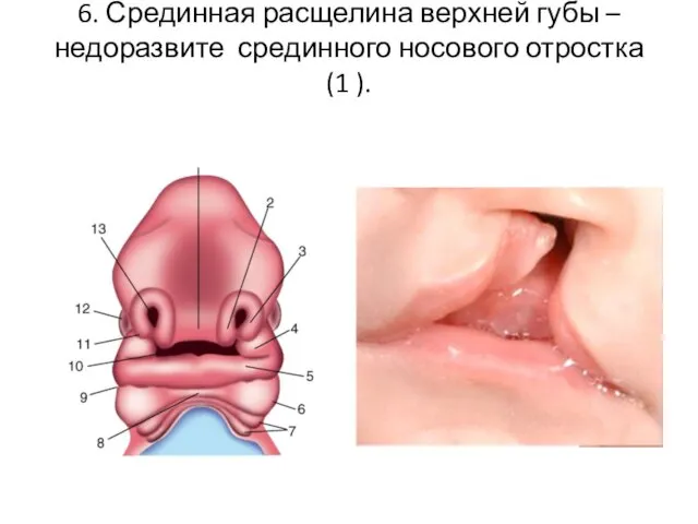 6. Срединная расщелина верхней губы – недоразвите срединного носового отростка (1 ).