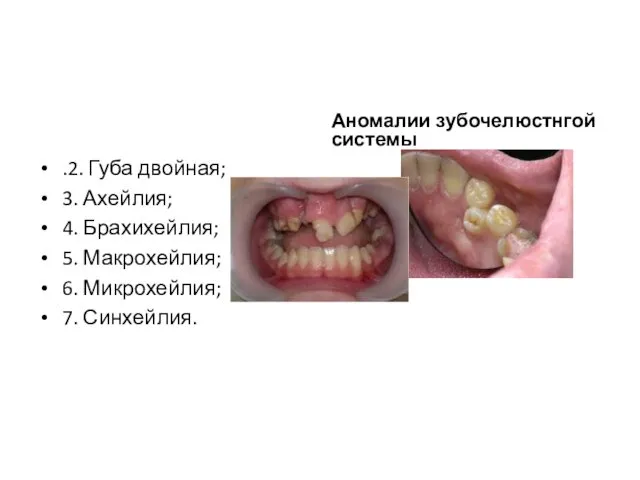 .2. Губа двойная; 3. Ахейлия; 4. Брахихейлия; 5. Макрохейлия; 6. Микрохейлия; 7. Синхейлия. Аномалии зубочелюстнгой системы