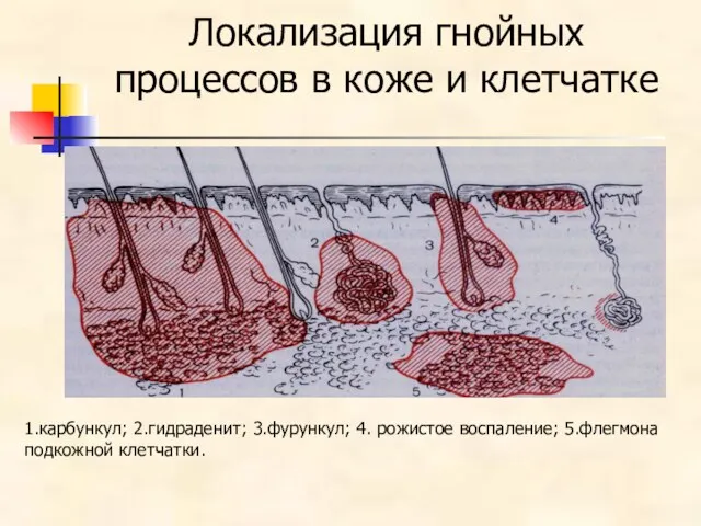 Локализация гнойных процессов в коже и клетчатке 1.карбункул; 2.гидраденит; 3.фурункул; 4. рожистое воспаление; 5.флегмона подкожной клетчатки.