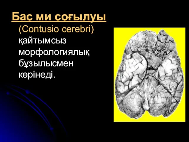Бас ми соғылуы (Contusio cerebri) қайтымсыз морфологиялық бұзылысмен көрінеді.