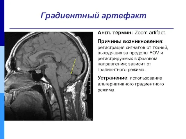 Англ. термин: Zoom artifact. Причины возникновения: регистрация сигналов от тканей,