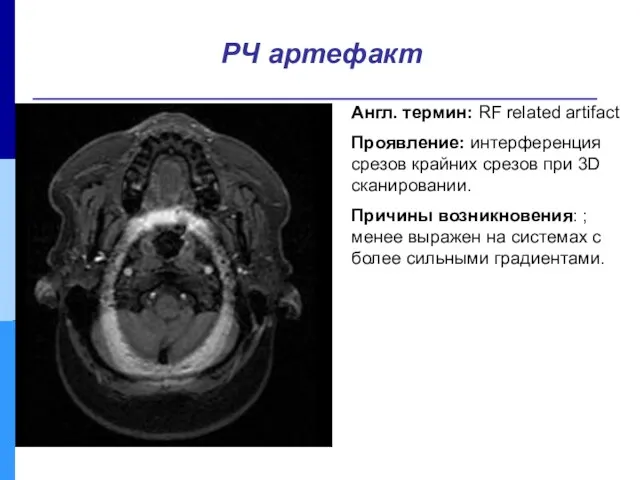 Англ. термин: RF related artifact Проявление: интерференция срезов крайних срезов