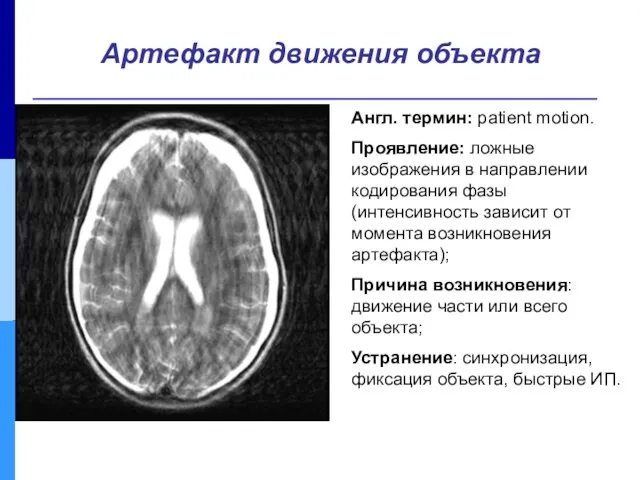 Англ. термин: patient motion. Проявление: ложные изображения в направлении кодирования