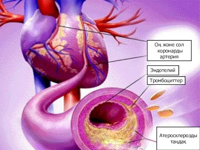 Оң және сол коронарды артерия Эндотелий Тромбоциттер Атеросклерозды таңдақ
