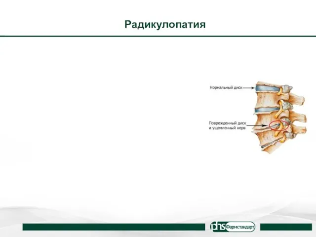 Радикулопатия