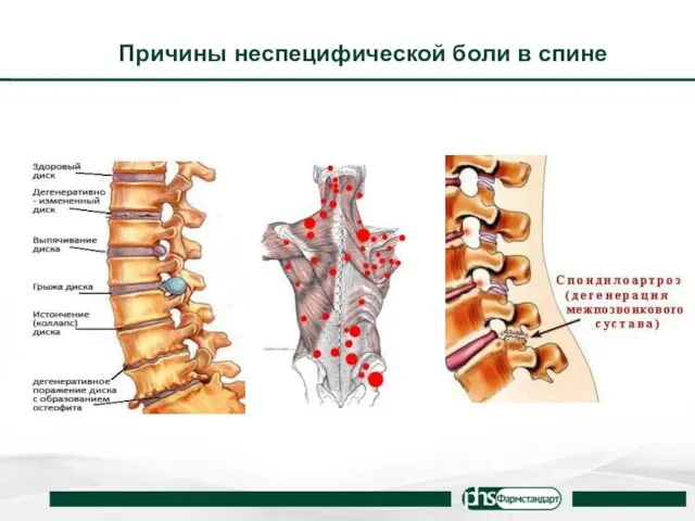 Причины неспецифической боли в спине