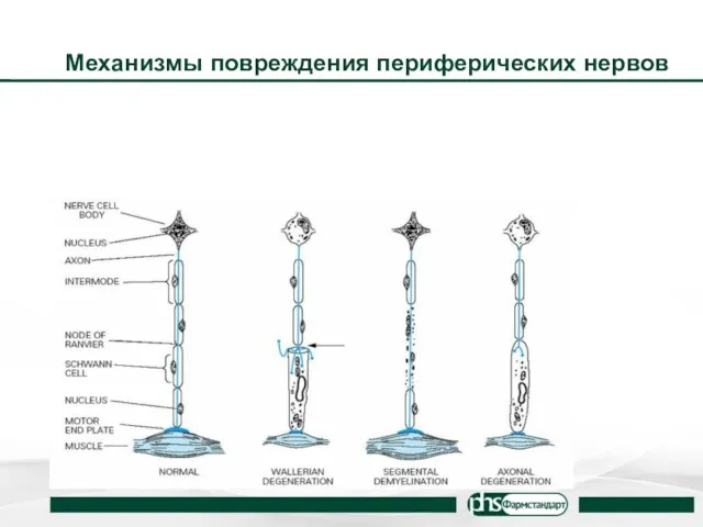 Механизмы повреждения периферических нервов