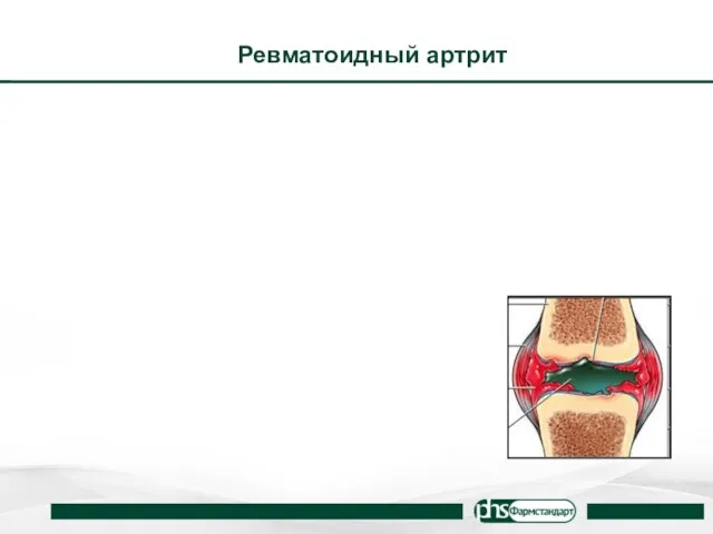 Ревматоидный артрит