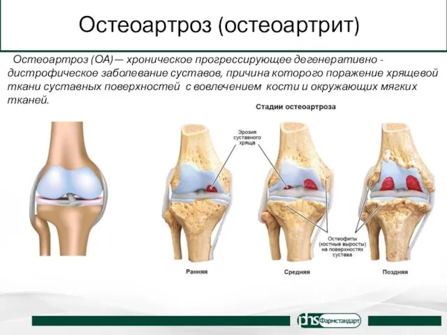 Остеоартроз (остеоартрит) Остеоартроз (ОА)— хроническое прогрессирующее дегенеративно - дистрофическое заболевание