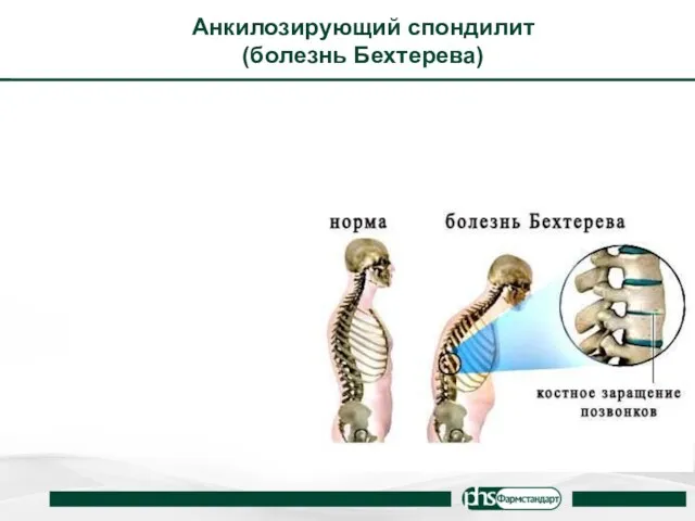 Анкилозирующий спондилит (болезнь Бехтерева)