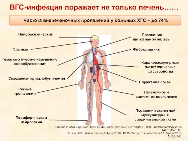 ВГС-инфекция поражает не только печень…… Cacoub P, et al. Dig Liver Dis 2014;