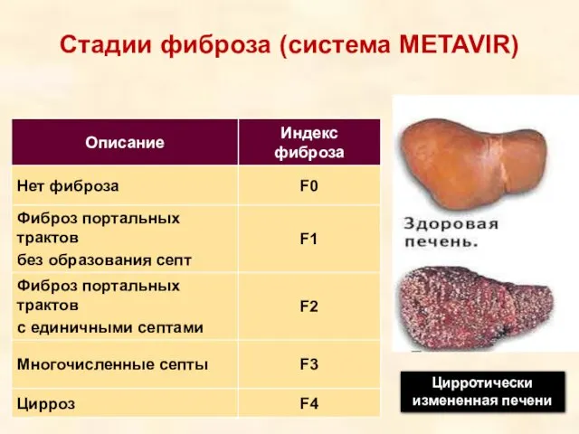 Стадии фиброза (система METAVIR) Цирротически измененная печени