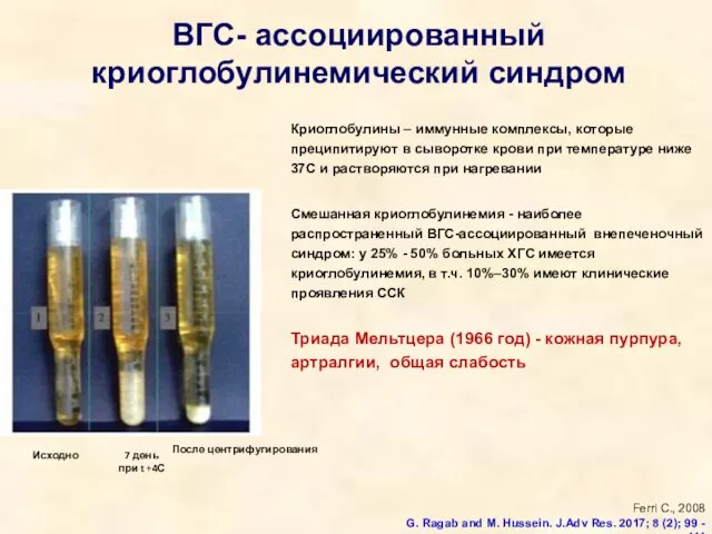 ВГС- ассоциированный криоглобулинемический синдром Криоглобулины – иммунные комплексы, которые преципитируют в сыворотке крови