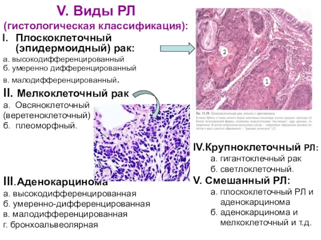 V. Виды РЛ (гистологическая классификация): Плоскоклеточный (эпидермоидный) рак: а. высокодифференцированный б. умеренно дифференцированный
