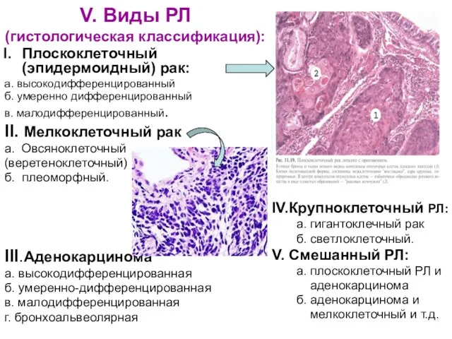 V. Виды РЛ (гистологическая классификация): Плоскоклеточный (эпидермоидный) рак: а. высокодифференцированный