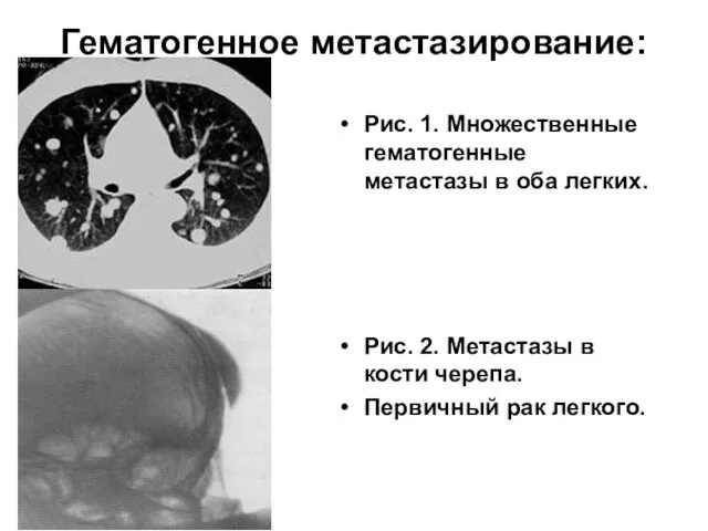 Гематогенное метастазирование: Рис. 1. Множественные гематогенные метастазы в оба легких. Рис. 2. Метастазы