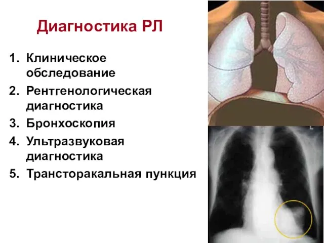 Диагностика РЛ Клиническое обследование Рентгенологическая диагностика Бронхоскопия Ультразвуковая диагностика Трансторакальная пункция