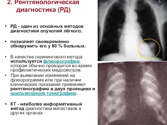 2. Рентгенологическая диагностика (РД) РД - один из основных методов диагностики опухолей лёгкого,