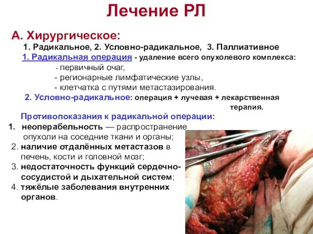 Лечение РЛ А. Хирургическое: 1. Радикальное, 2. Условно-радикальное, 3. Паллиативное