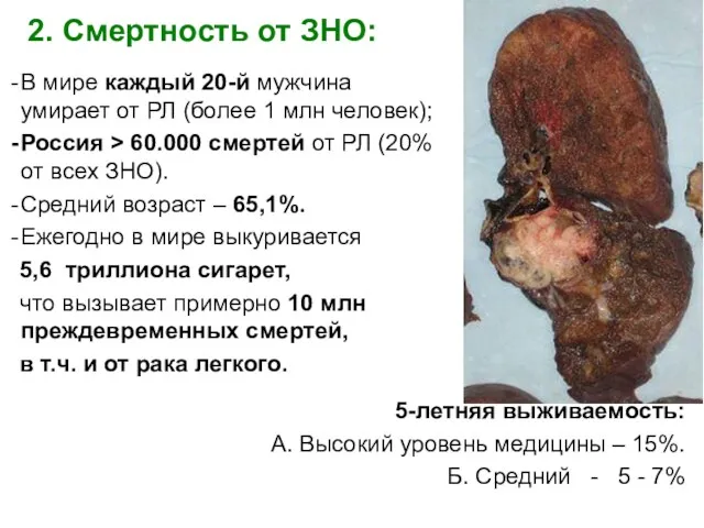 2. Смертность от ЗНО: В мире каждый 20-й мужчина умирает от РЛ (более