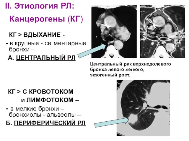 II. Этиология РЛ: Канцерогены (КГ) КГ > ВДЫХАНИЕ - -