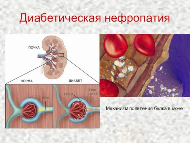 Диабетическая нефропатия Механизм появления белка в моче