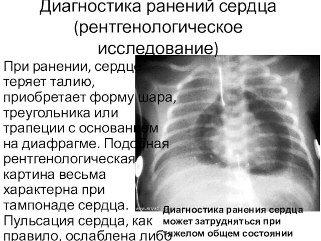 Диагностика ранений сердца (рентгенологическое исследование) При ранении, сердце теряет талию,