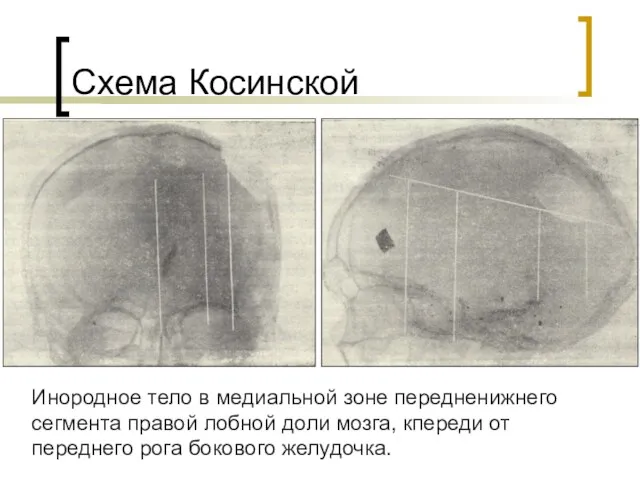 Схема Косинской Инородное тело в медиальной зоне передненижнего сегмента правой лобной доли мозга,