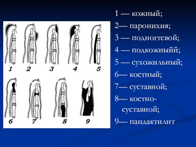 1 — кожный; 2— паронихия; 3 — подногтевой; 4 —