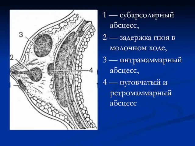 1 — субареолярный абсцесс, 2 — задержка гноя в молочном