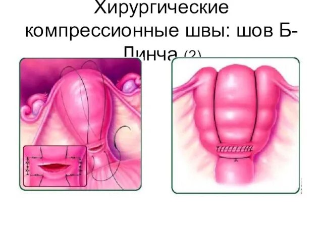 Хирургические компрессионные швы: шов Б-Линча (2)