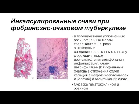 Инкапсулированные очаги при фибринозно-очаговом туберкулезе в легочной ткани уплотненные эозинофильные массы творожистого некроза