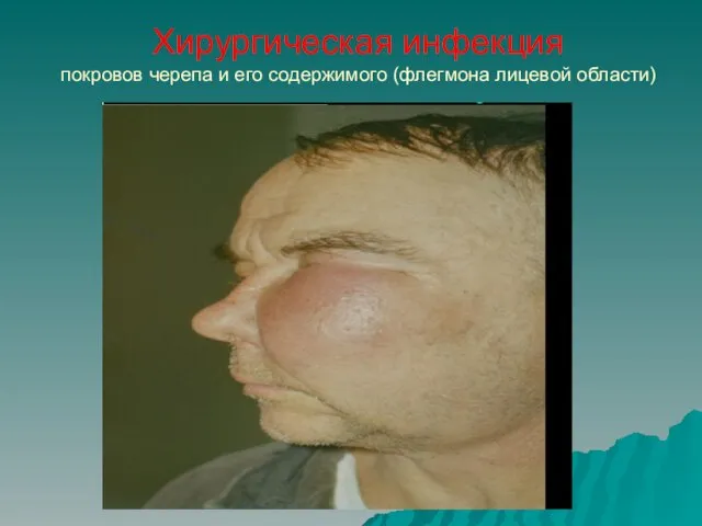 Хирургическая инфекция покровов черепа и его содержимого (флегмона лицевой области)