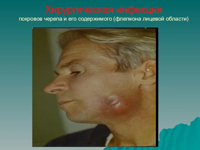 Хирургическая инфекция покровов черепа и его содержимого (флегмона лицевой области)