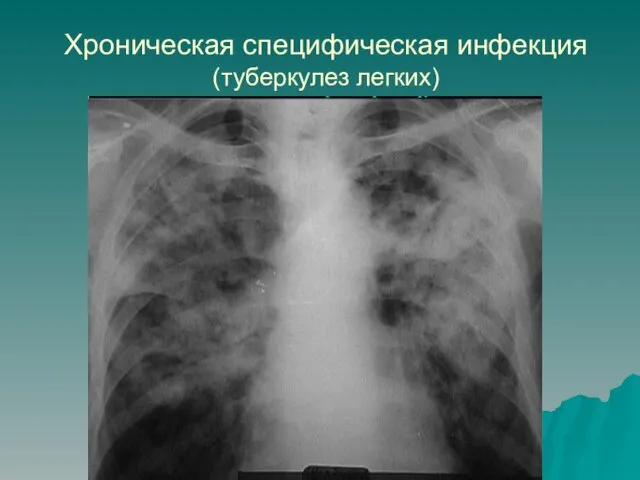 Хроническая специфическая инфекция (туберкулез легких)