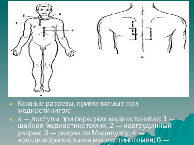 Кожные разрезы, применяемые при медиастинитах: а — доступы при передних медиастинитах: 1 —