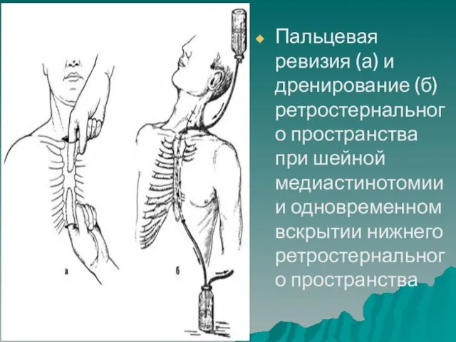 Пальцевая ревизия (а) и дренирование (б) ретростернального пространства при шейной