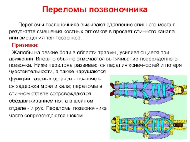 Переломы позвоночника Переломы позвоночника вызывают сдавление спинного мозга в результате