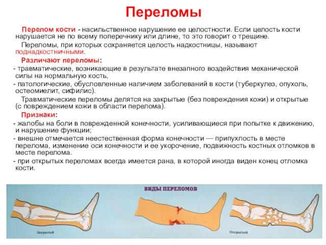 Переломы Перелом кости - насильственное нарушение ее целостности. Если целость