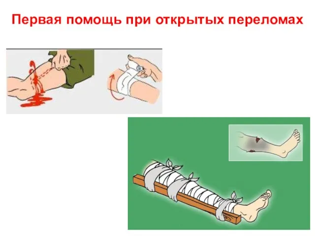 Первая помощь при открытых переломах