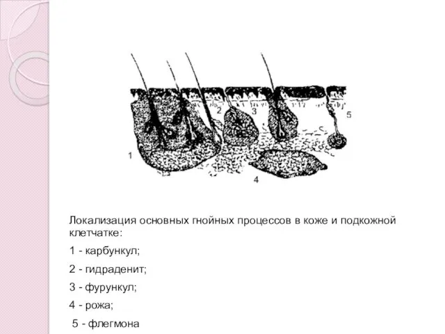 Локализация основных гнойных процессов в коже и подкожной клетчатке: 1