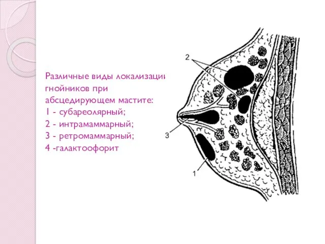 Различные виды локализации гнойников при абсцедирующем мастите: 1 - субареолярный;