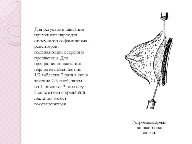 Ретромаммарная новокаиновая блокада Для регуляции лактации применяют парлодел - стимулятор
