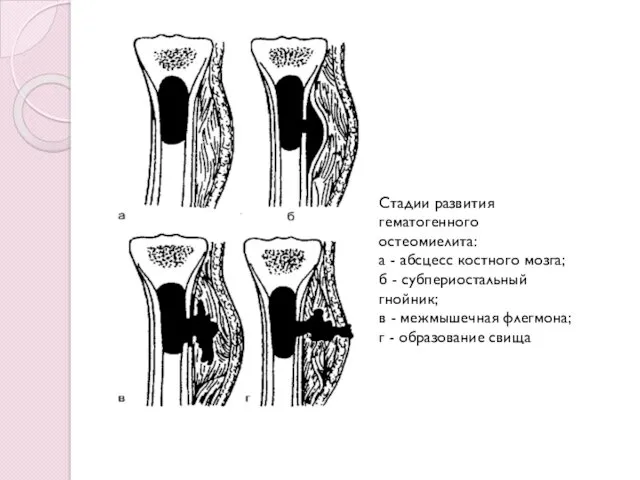Стадии развития гематогенного остеомиелита: а - абсцесс костного мозга; б
