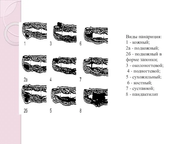 Виды панариция: 1 - кожный; 2а - подкожный; 2б -