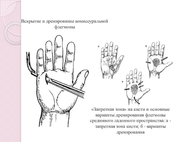 Вскрытие и дренирование комиссуральной флегмоны «Запретная зона» на кисти и