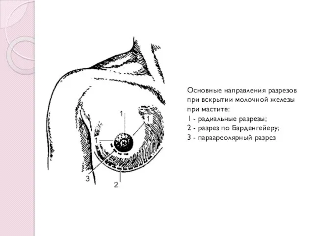 Основные направления разрезов при вскрытии молочной железы при мастите: 1