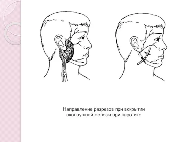 Направление разрезов при вскрытии околоушной железы при паротите